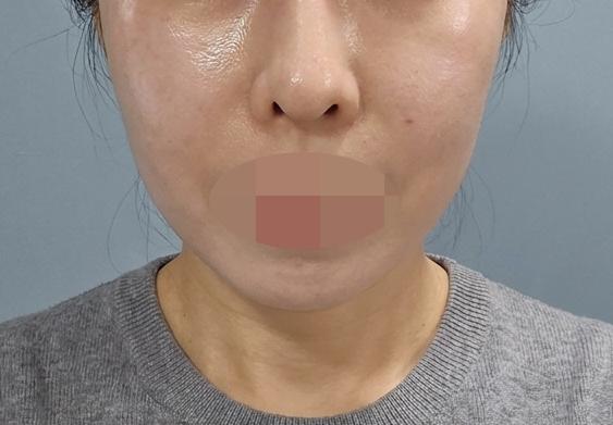 흉터 하나 없이 일상생활 바로 가능! 만족해서 재방문 예정이에요~ㅎㅎ