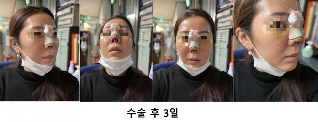 Revision Nose Surgery