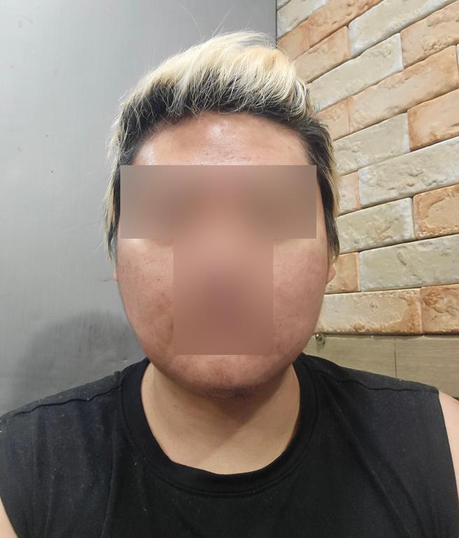 面部吸脂