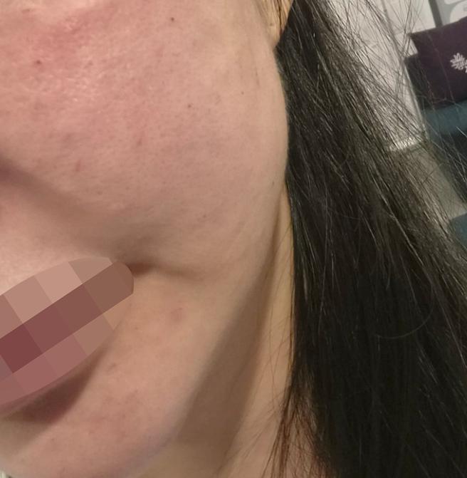 급하게 방문했는데 바로 시술 가능했어요~ 너무 만족이에요!