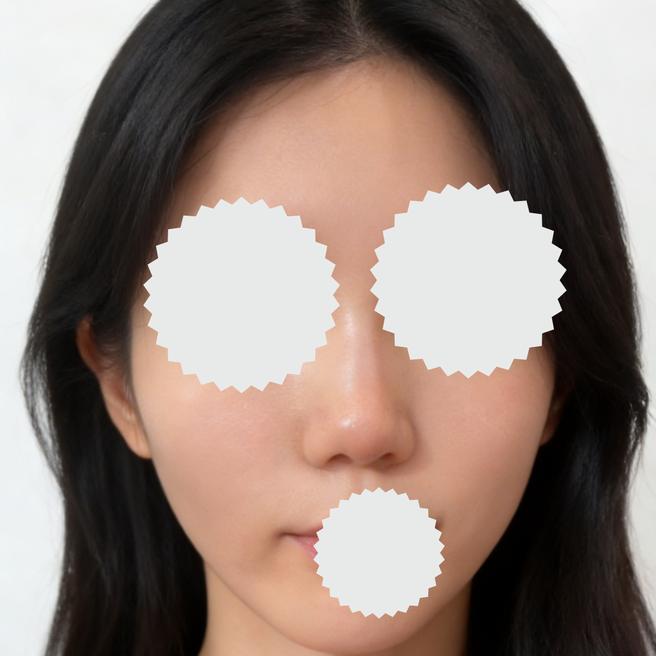 리쥬란 맞은 지 2주 됐어요! 피부가 뭔가 달라진 것 같은 느낌?