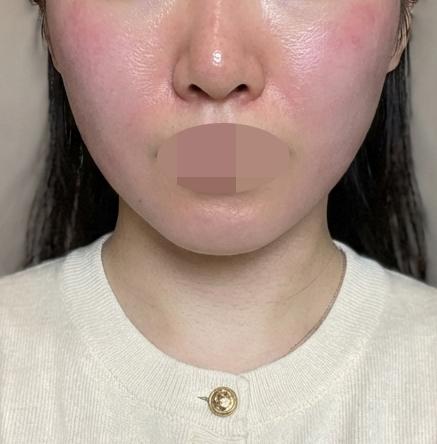 얼굴 라인이 무너지는 것 같아서 인모드 받아봤어요!