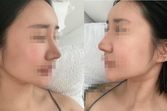 Revision Nose Surgery