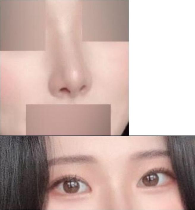 安全的眼部修正手術