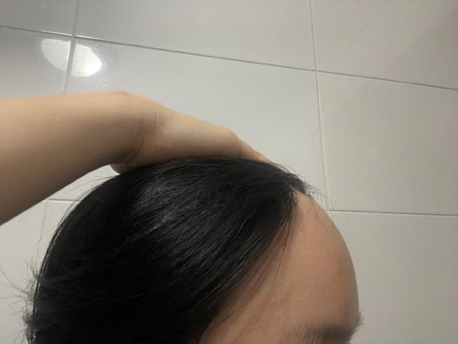 額頭縮小