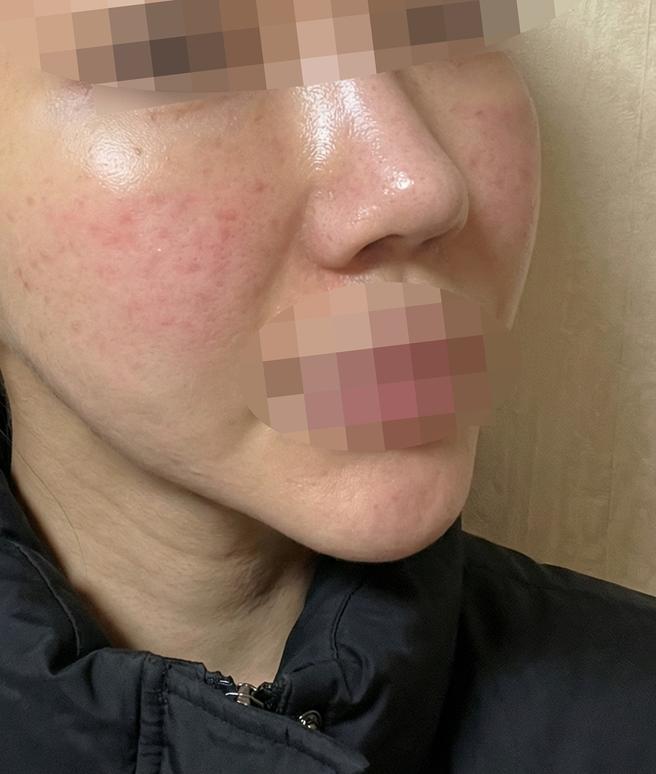 다운타임 짧고, 시술도 만족스러워요~ㅎㅎ