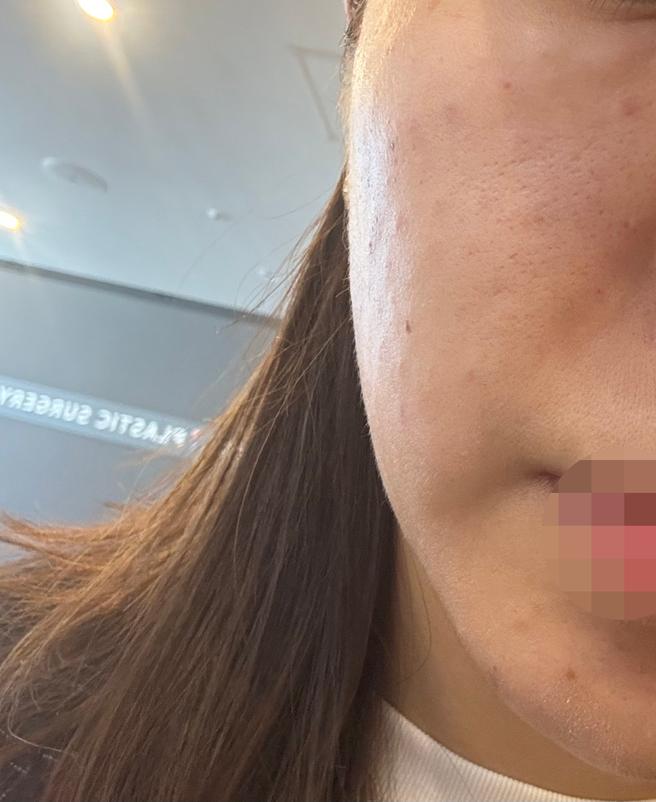 팔자주름 고민으로 리쥬써마, 믿고 또 찾아왔어요ㅎㅎ