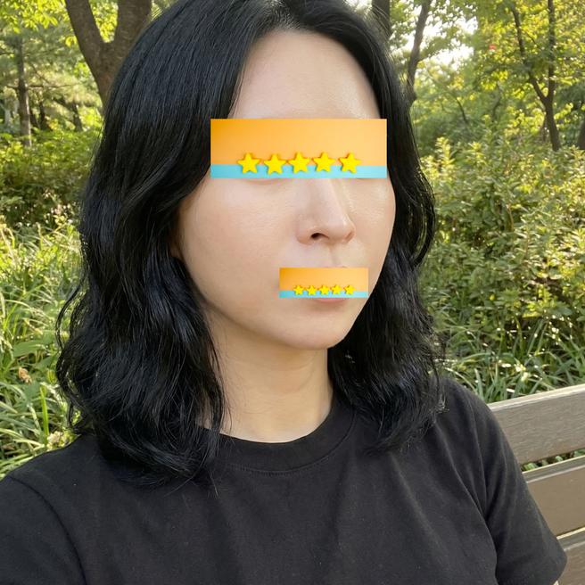 리쥬란 1개월, 이제 효과 제대로 느껴져요