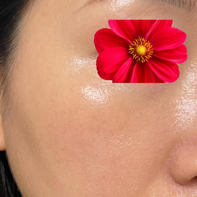 써마지 맞은 지 3일째! 붓기 빠지고 나니까 피부가 진짜 달라 보여요