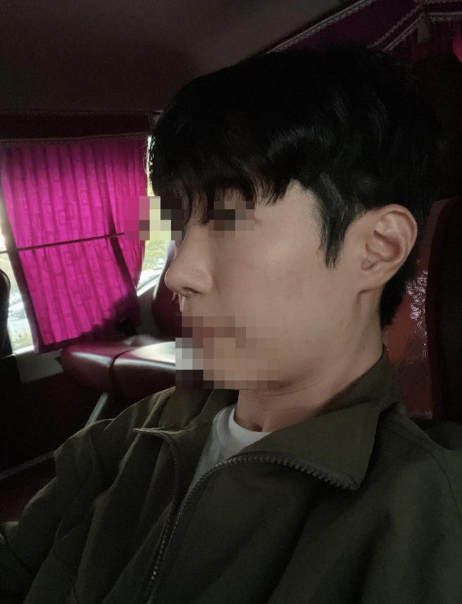 남자코성형
