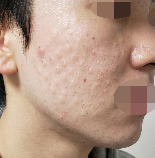 피부 장벽 강화하고자 리쥬란 선택했고 속건조부터 달라졌습니다!