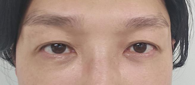 重新定位眼下脂肪