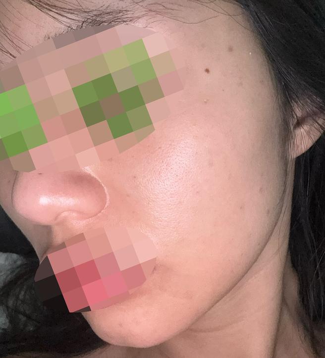 얼굴 칙칙해서 리쥬란힐러 받았는데 괜찮은 것 같아요 ㅎㅎ