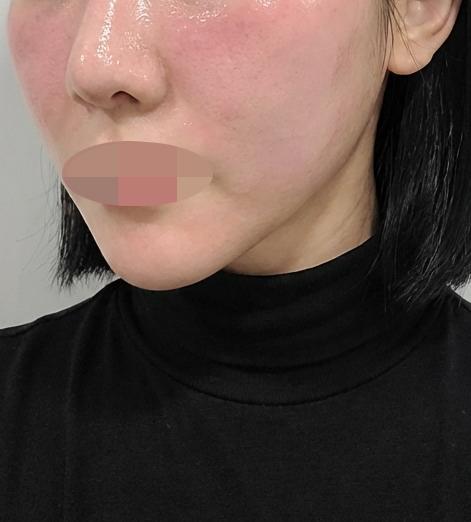 화장이 예전처럼 안 먹히더니 엑소좀으로 다시 진행했어!