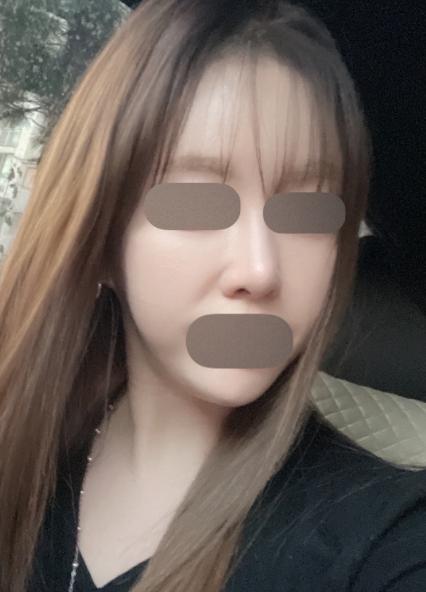 리쥬란 일주일 다 돼가는데 이제 슬슬 효과가 보이는 것 같아요 