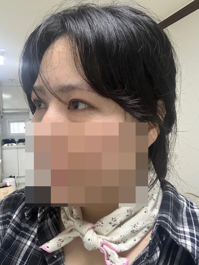 눈매교정&안검하수