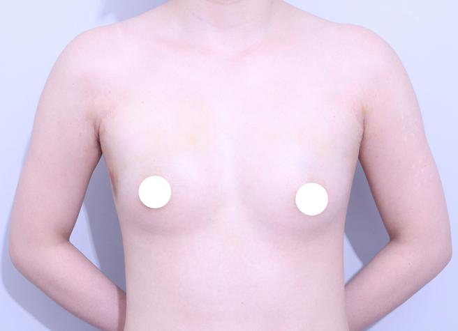 Stem Cell Chest Fat Grafting