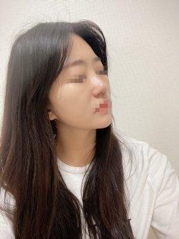 안심 코 재수술