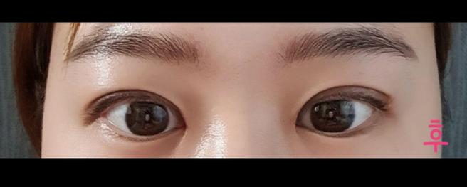 ศัลยกรรมตาแก้ไขอย่างมั่นใจ