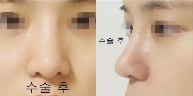 ศัลยกรรมจมูกครั้งแรก