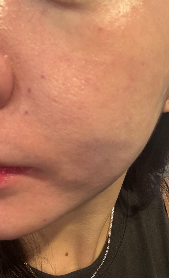 눈밑 잔주름이랑 모공, 홍조 고민으로 아이리쥬란 처음 받아봤어요