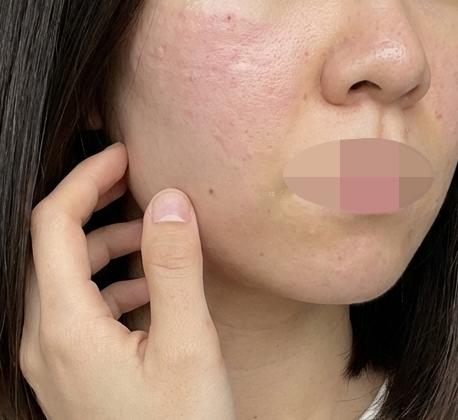 속광 채우고 화장 들뜸 잡으려고 리쥬란 받아봤어요!!