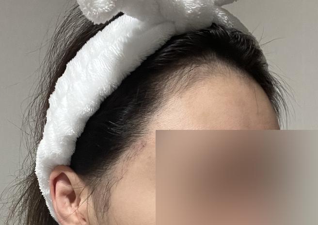 무삭발모발이식