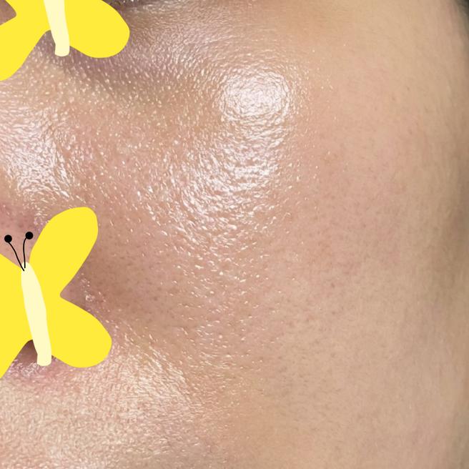 스킨보톡스 맞은 지 3일 됐어요~~^^ 경과 공유!ㅎㅎ
