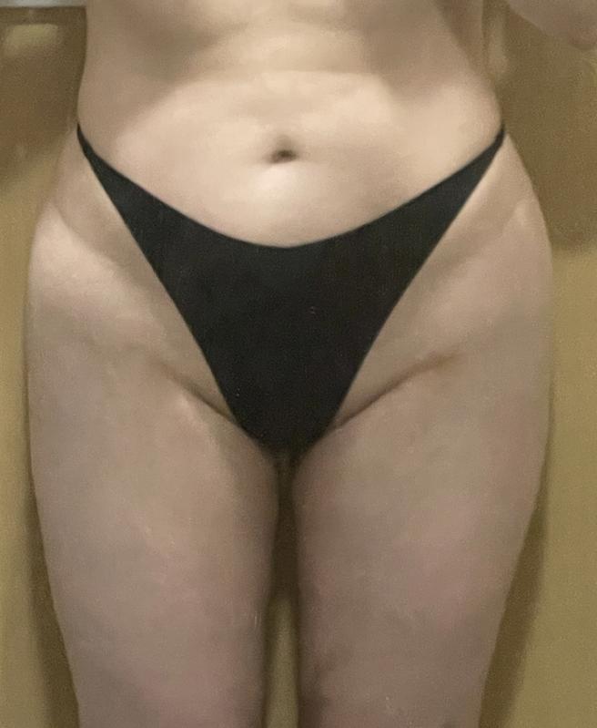 体脂肪移植