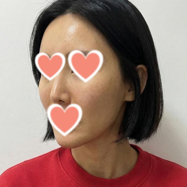 쥬브아셀 8% 6CC