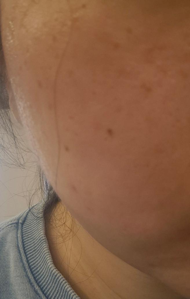 모공 때문에 찾아봤는데 포텐자가 제일 좋다길래 바로 예약했어요