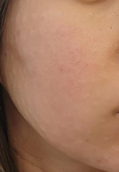 홍조+모공+속건조 고민에 리쥬란힐러 1일차 후기