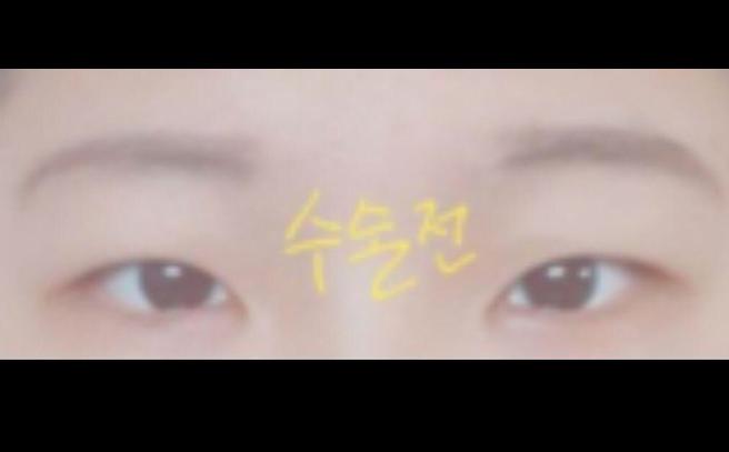 절개쌍꺼풀
