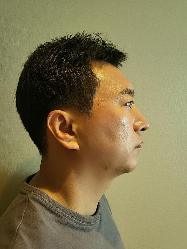 男性隆鼻術
