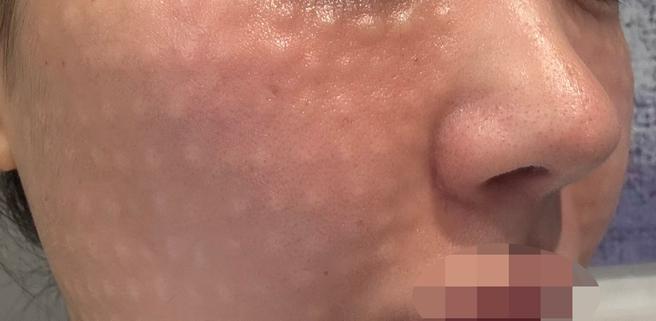 전문의한테 합리적인 가격으로 리쥬란 받았습니다!!