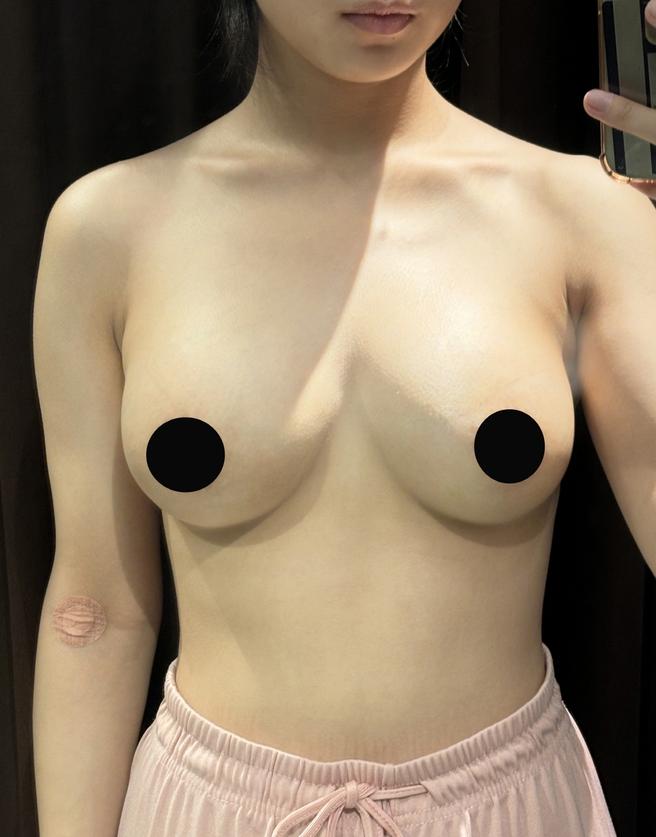 Stem Cell Chest Fat Grafting