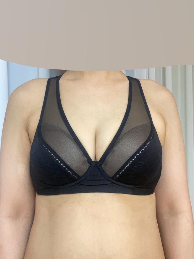 PRP Breast Fat Grafting