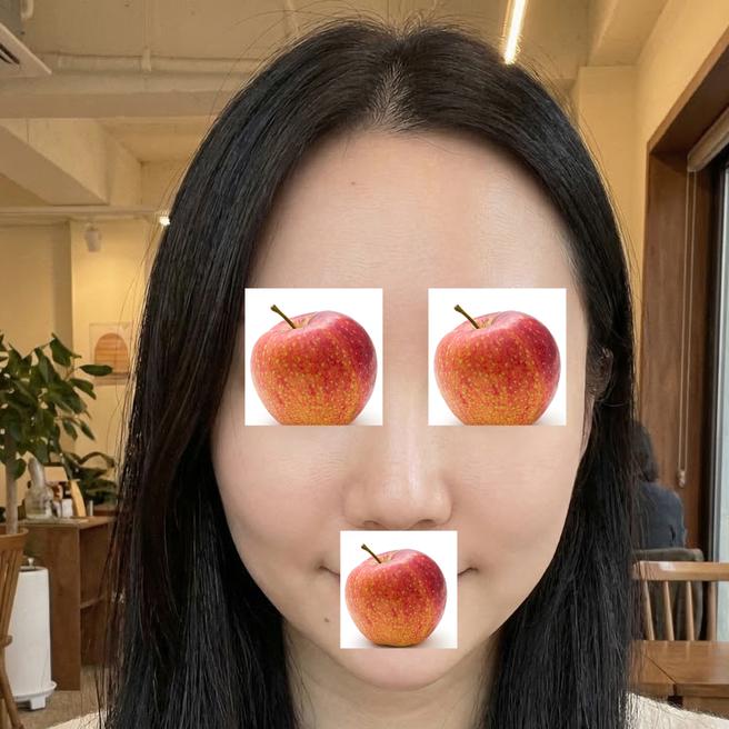 온다+리쥬란 맞은 지 2주, 주변에서 피부 좋아졌다는 말 듣기 시작했어요 ㅎㅎ 