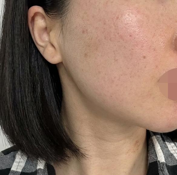 좁쌀 여드름이랑 속건조 고민, 리쥬란으로 해결하러 왔어요~