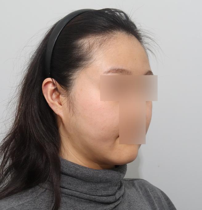얼굴 지방흡입