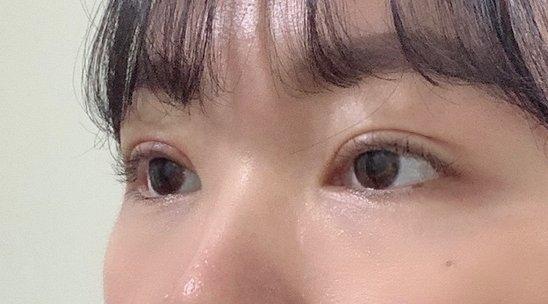 眼型矯正與上瞼下垂矯正