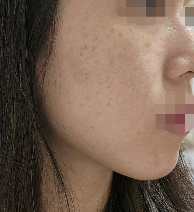 써마지 600샷 처음인데 바로 팔자주름 옅어져서 신기해요 ㅎㅎ