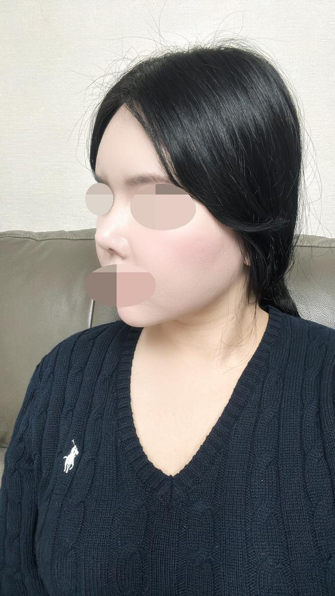 자가늑연골코재수술