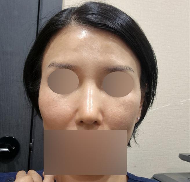 안심 코 재수술