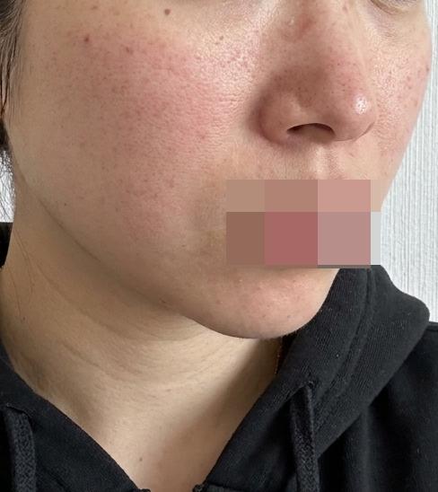수면으로 아픔 없이! 한 번에 관리 가능한 리쥬쎄라 강추예요