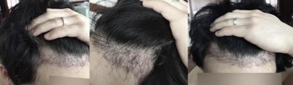 디테일헤어라인교정