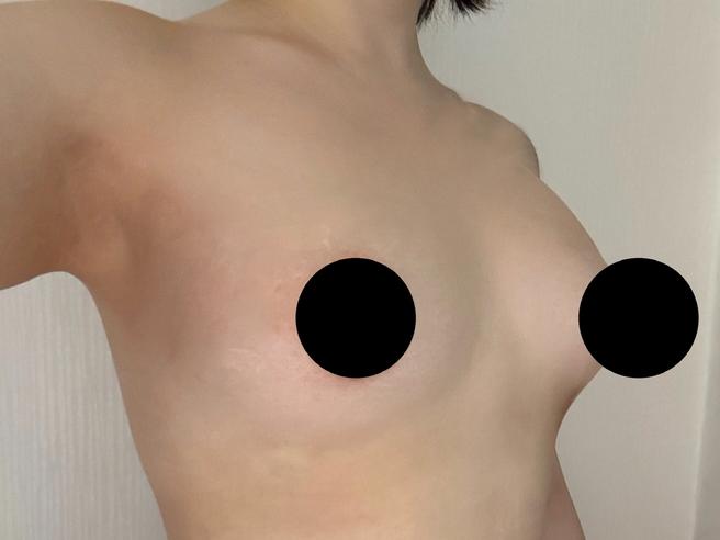 Stem Cell Chest Fat Grafting