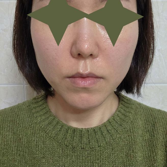 스컬트라 첫 시술 3일차 리얼 경과 사진 공개해요