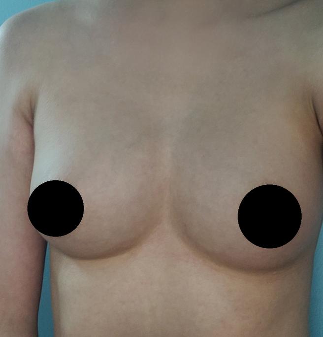 PRP Breast Fat Grafting