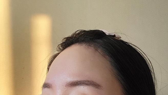 額頭縮小